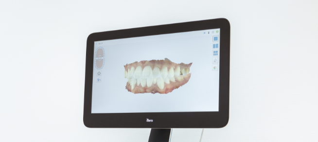 iTeroによる精密で正確な印象採得